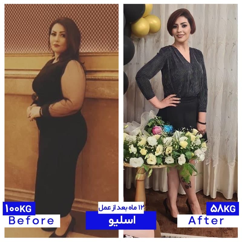 ۵۰ کیلو کاهش وزن پس از اسلیو معده