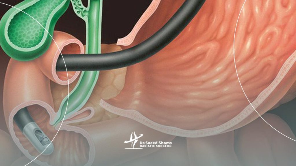 تشخیص فتق های هیاتال