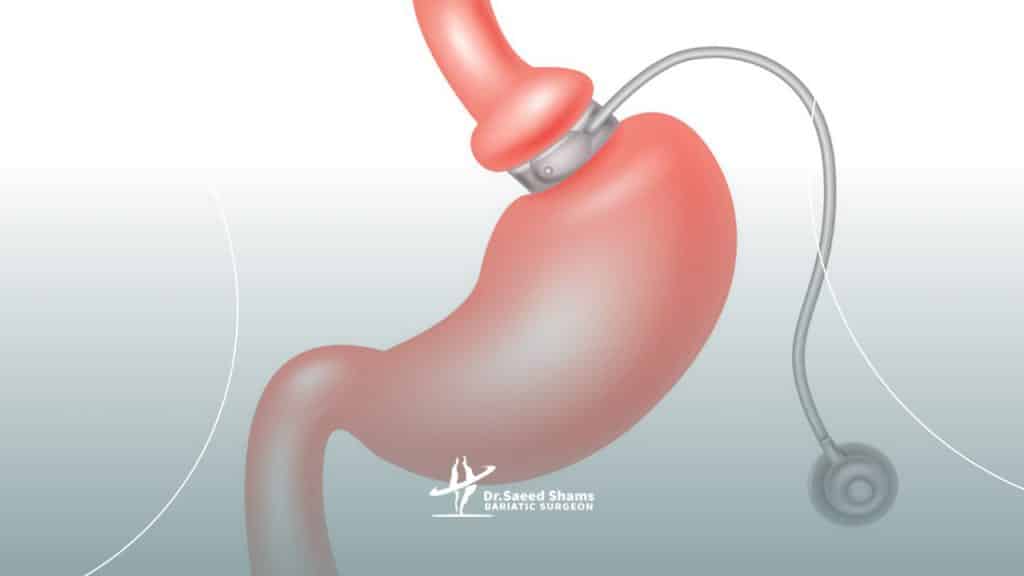 باندینگ معده