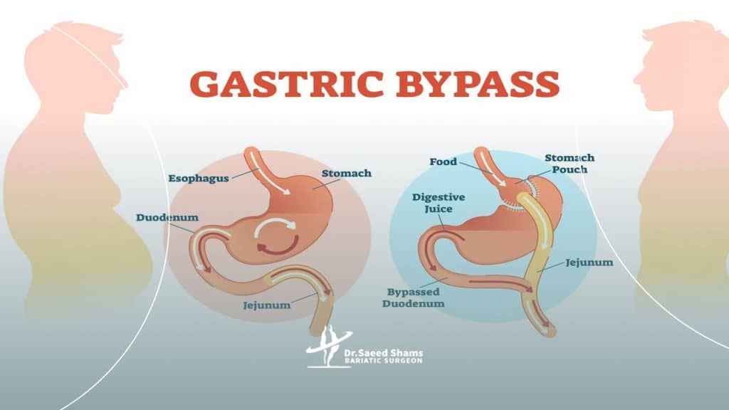 جراحی لاغری بای پس