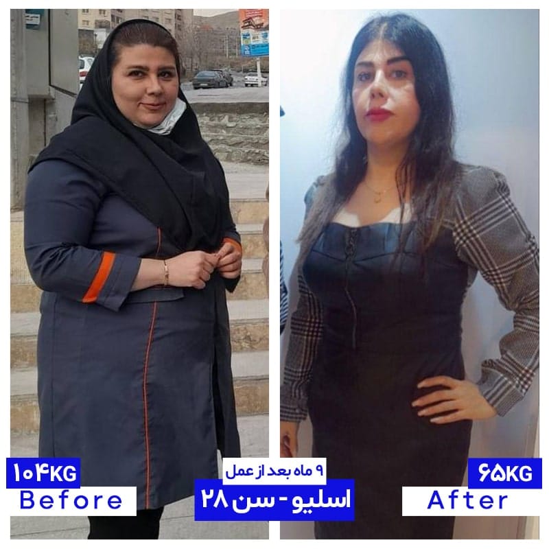 ۴۰ کیلو کاهش وزن پس از اسلیو معده