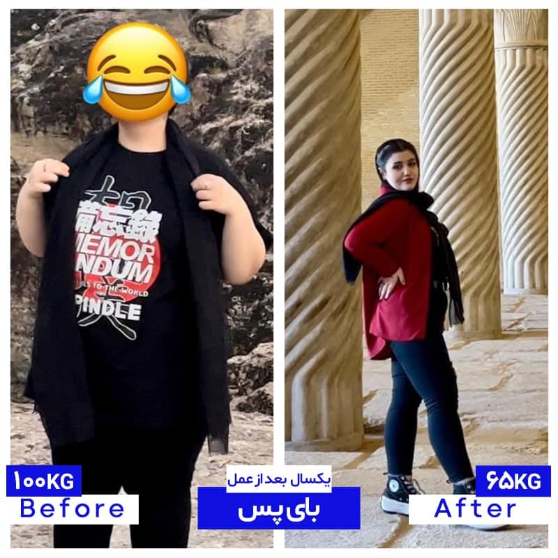 رضایت پس از عمل بای پس