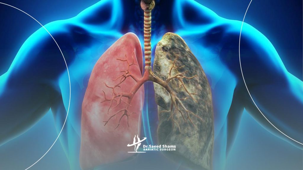 عفونت ریه را در تصویر مشاهده میکنید