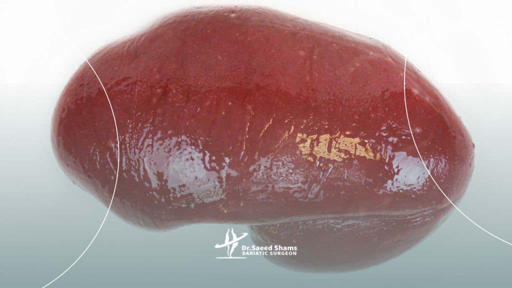 ضعف طحال چیست؟