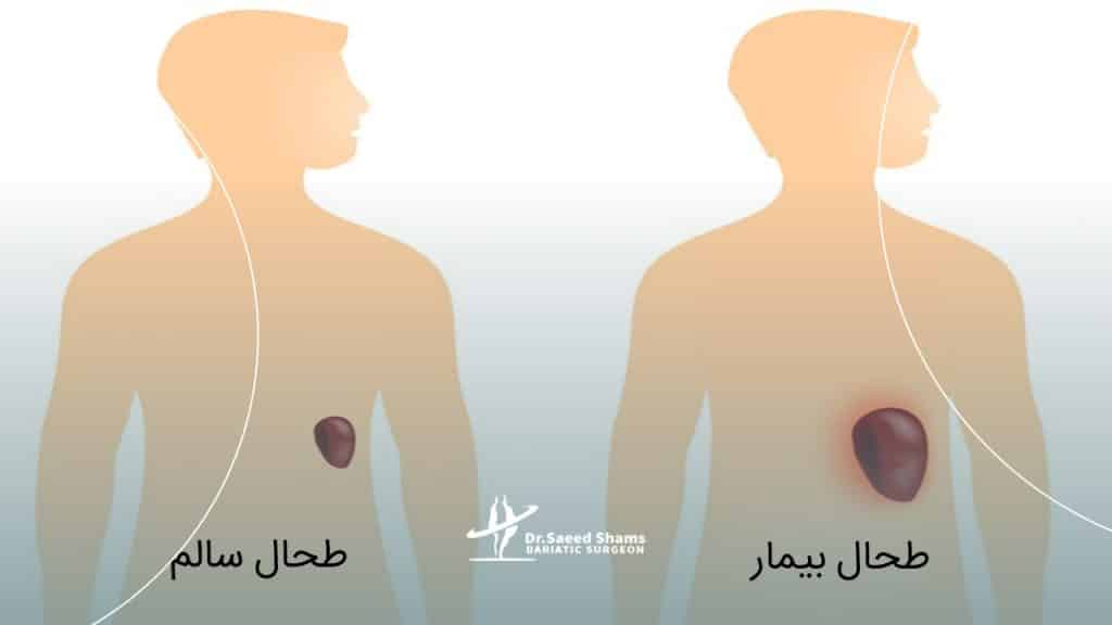 کارکرد طحال در بدن چیست؟