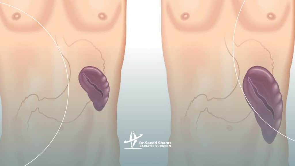 عوارض بزرگ شدن طحال چیست؟