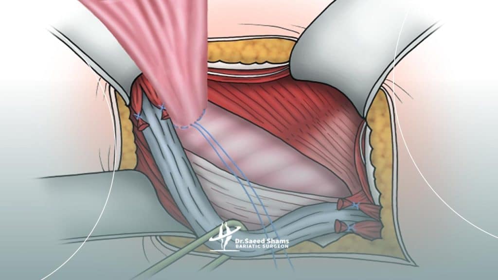 درمان فتق چیست؟