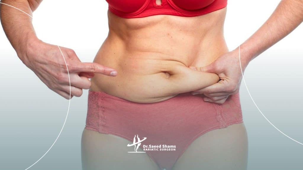 دلایل افتادگی پوست بعد از عمل اسلیو و بای پس چیست؟