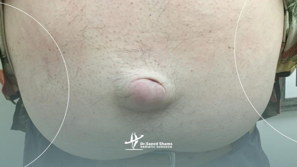 علائم باد فتق در زنان چیست؟