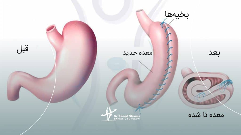عمل پلیسه معده چیست؟