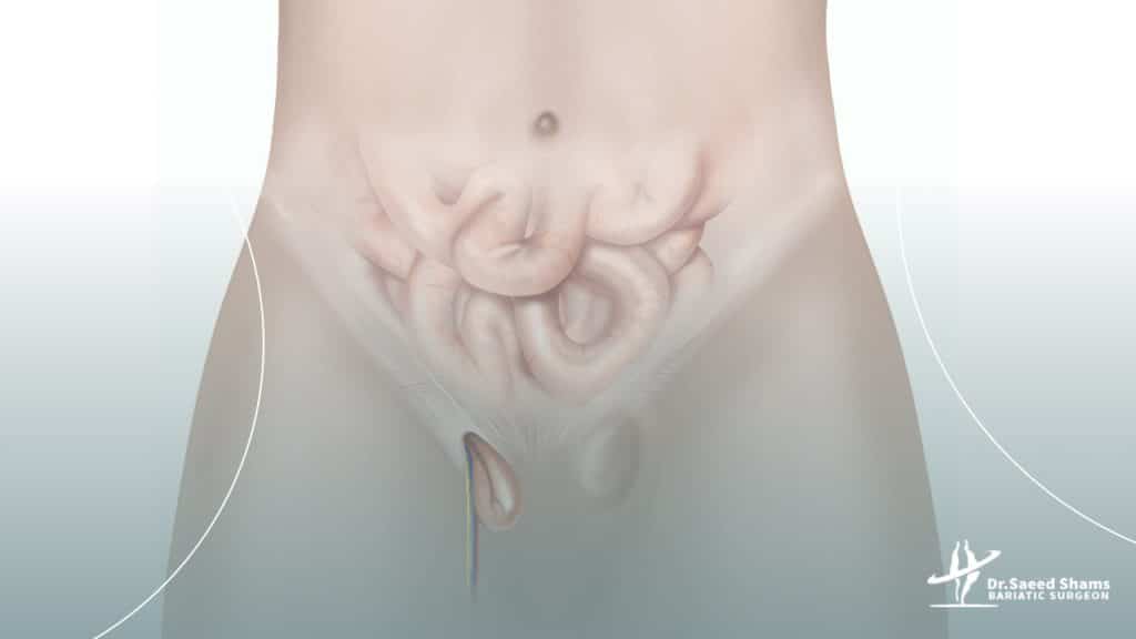 علائم فتق چیست؟