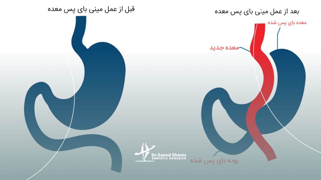 قبل و بعد از عمل مینی بای پس