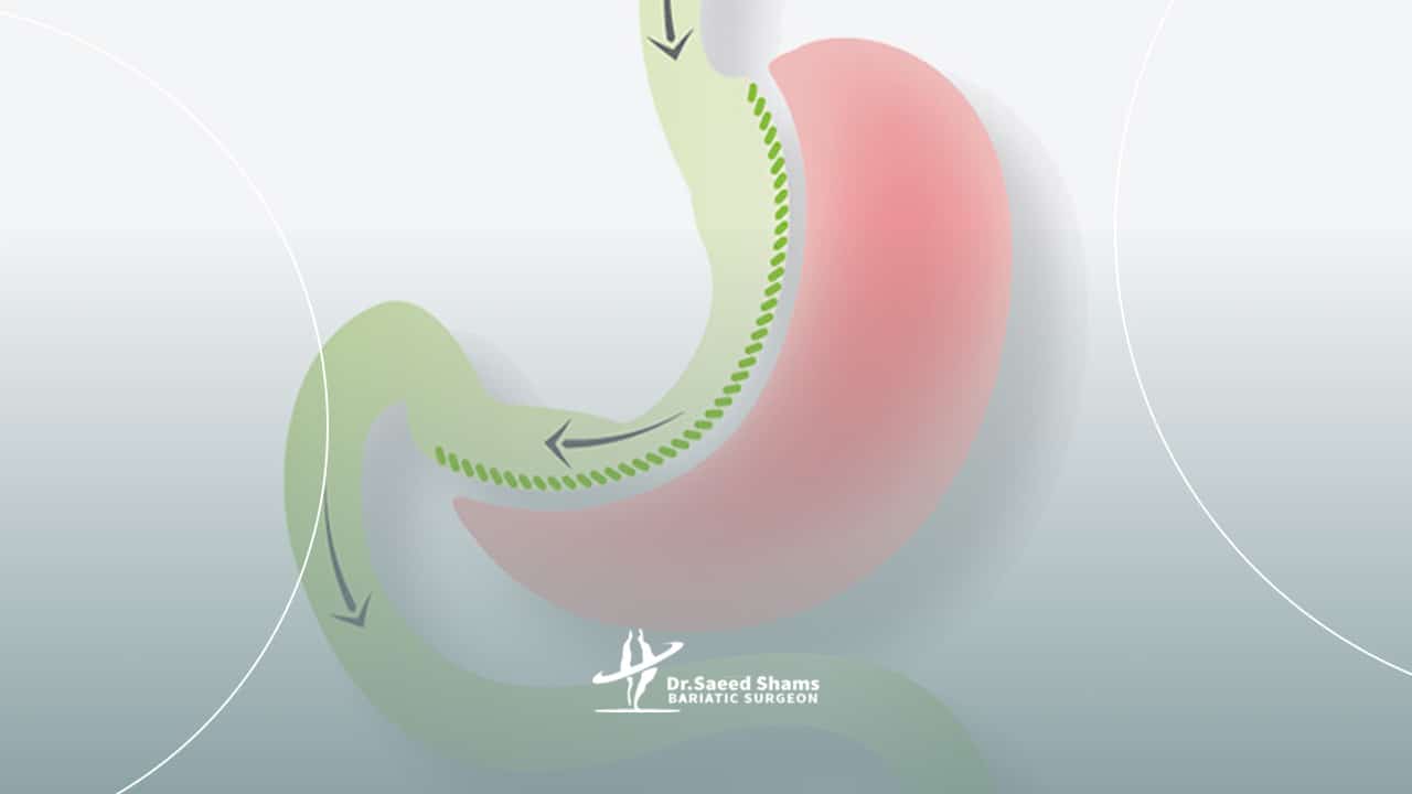 معده اسلیو شده