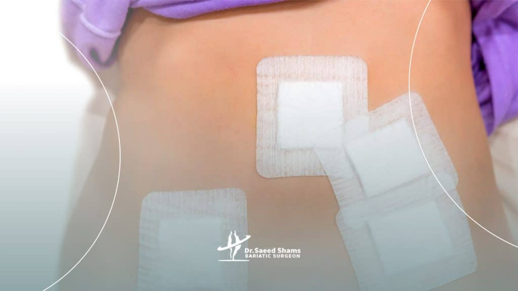 زخم بعد از لاپاراسکوپی