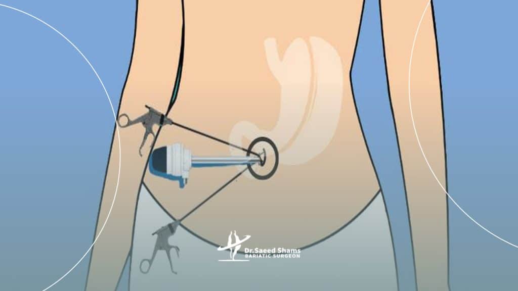 عمل اسلیو با لاپاراسکوپی