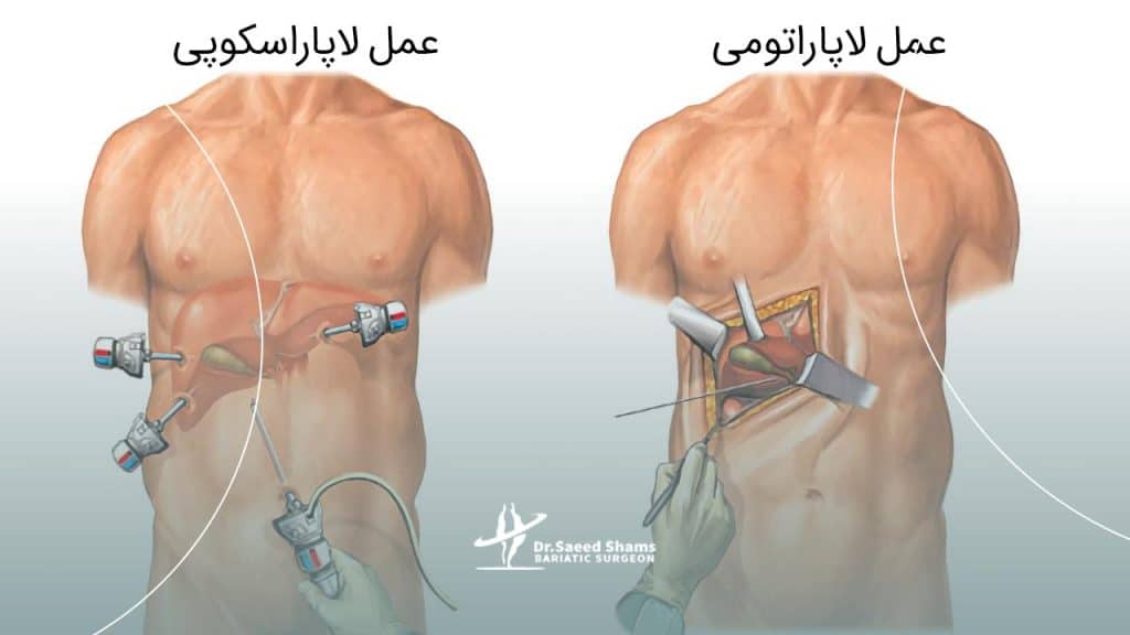 مقایسه جراحی لاپاراسکوپی با لاپاراتومی
