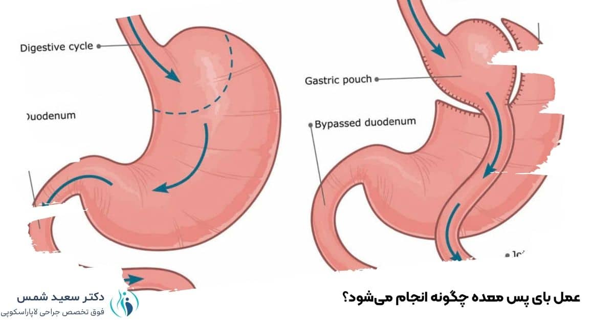 عمل بای پس معده چگونه انجام میشود؟