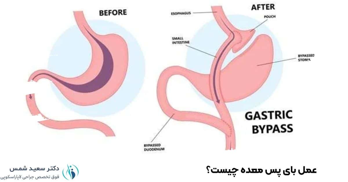 عمل بای پس معده چیست؟