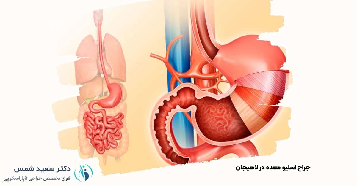 مشاوره جراحی اسلیو معده در لاهیجان - دکتر سعید شمس