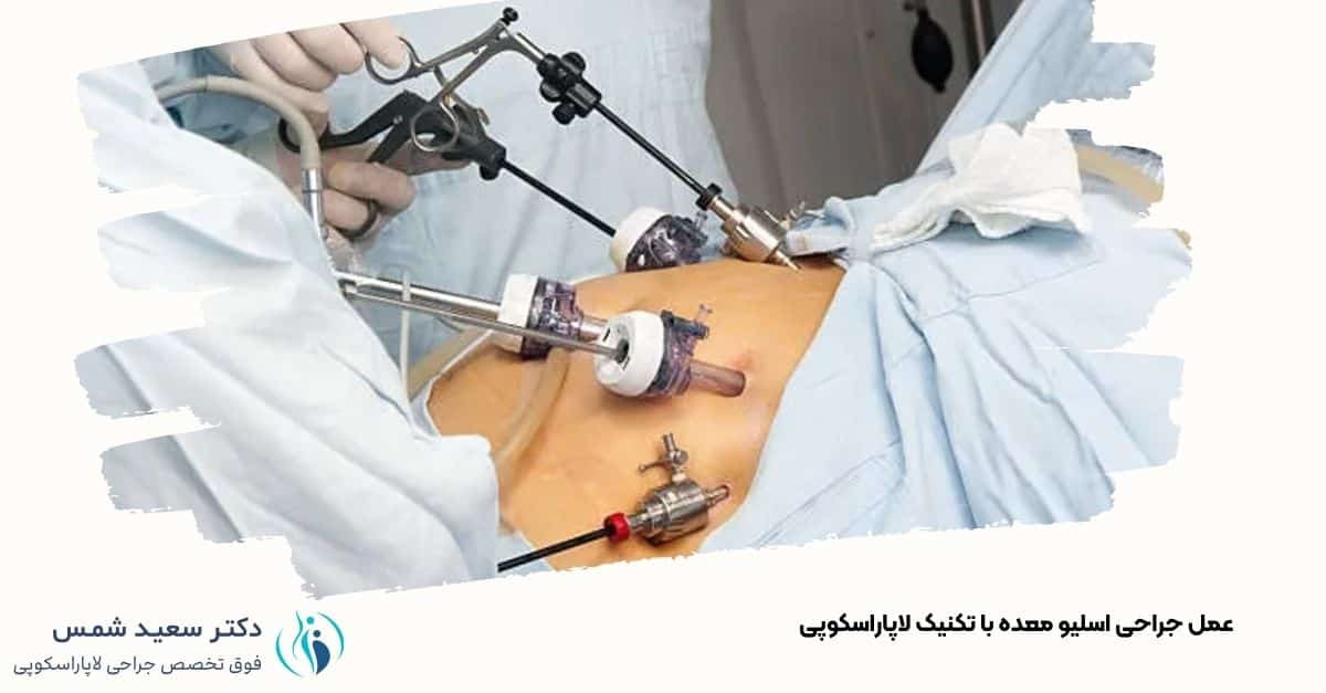 عمل اسلیو معده با لاپاراسکوپی در مرکز تخصصی - دکتر شمس