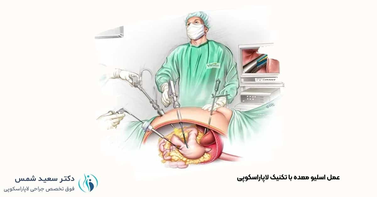 تصویر شماتیک از جراحی اسلیو معده با روش لاپاراسکوپی - دکتر شمس