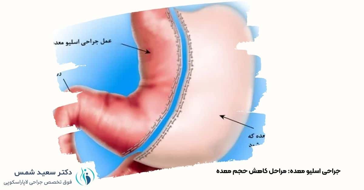 شماتیک جراحی اسلیو معده: نمایش بخش برداشتهشده معده و اتصال به روده. دکتر شمس