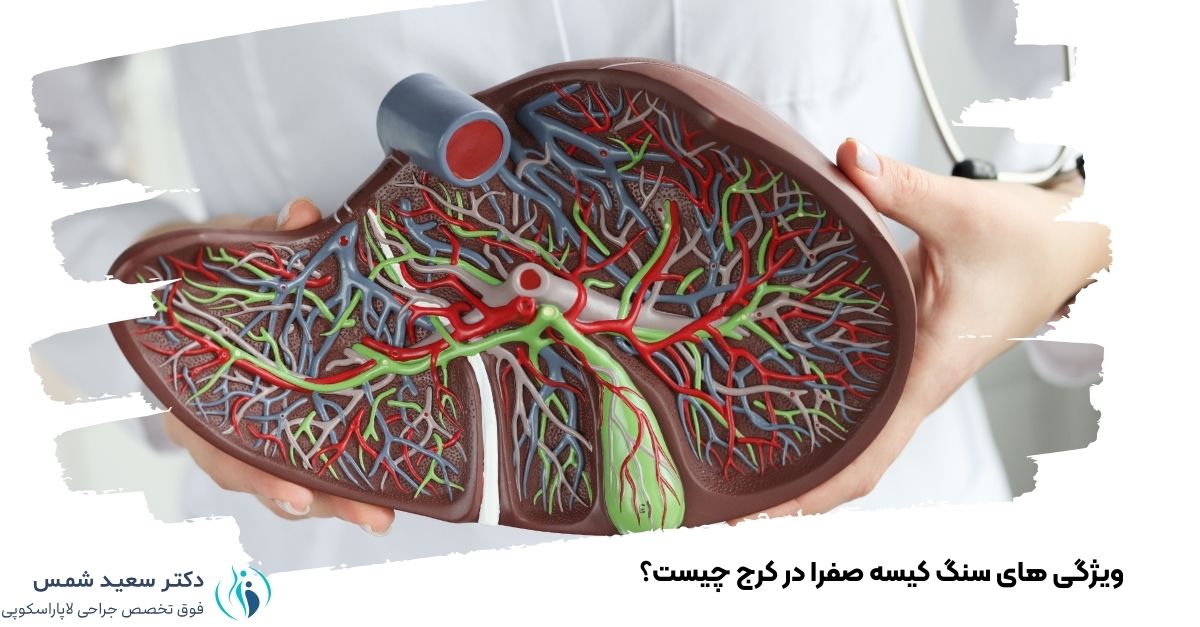 ویژگی های سنگ کیسه صفرا در کرج چیست؟