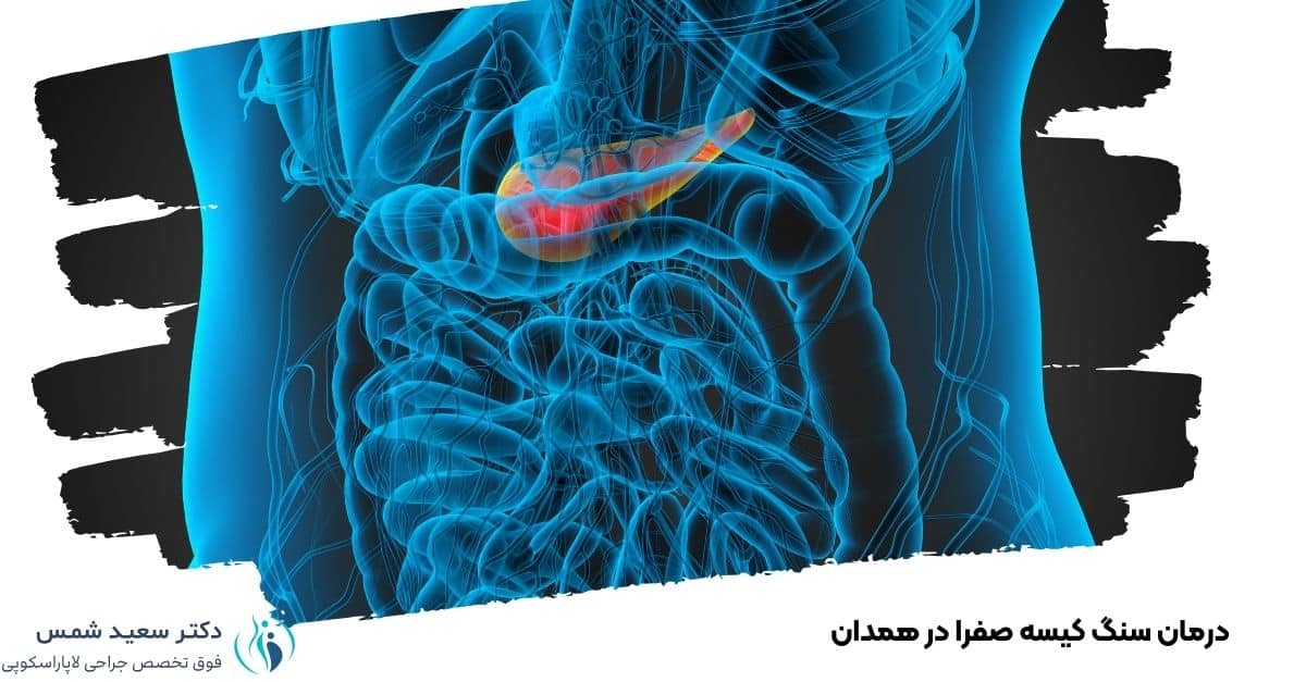 درمان سنگ کیسه صفرا در همدان