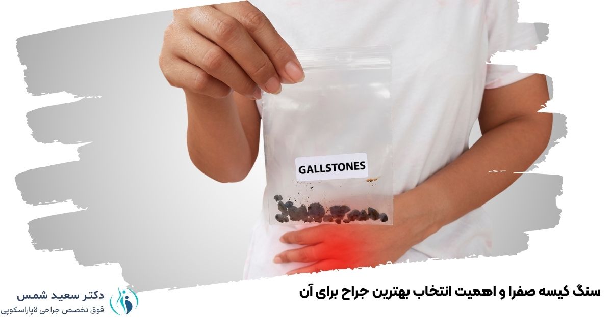 سنگ کیسه صفرا و اهمیت انتخاب بهترین جراح برای آن