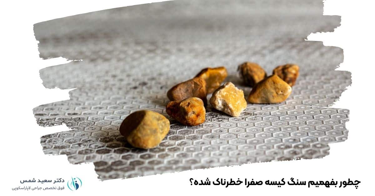 چطور بفهمیم سنگ کیسه صفرا خطرناک شده؟